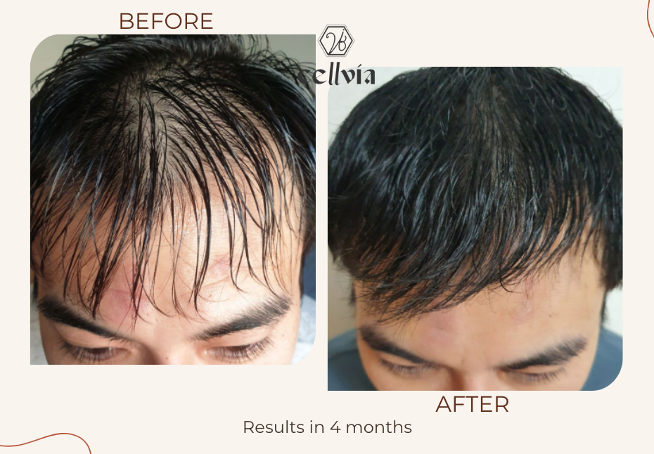 Hair Regrowth Miracle!