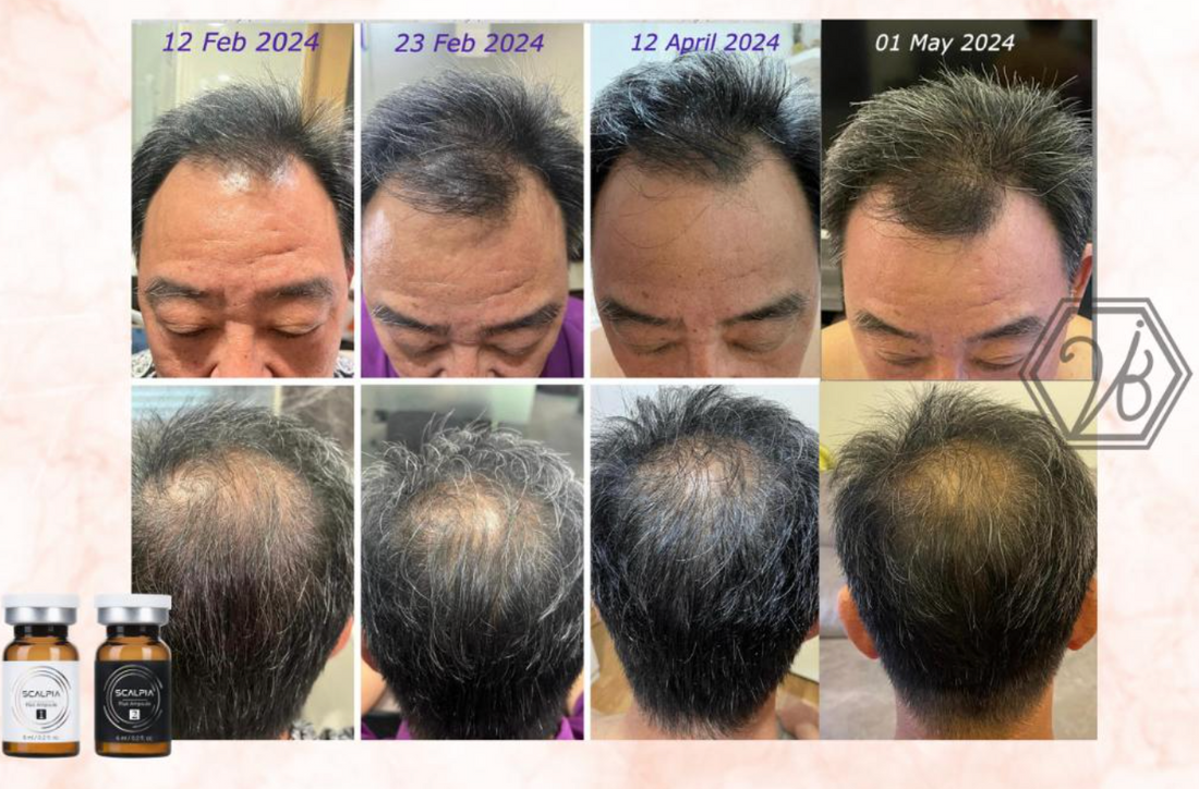 Visible Hair Growth In Just 3 Months of Using Scalpia!