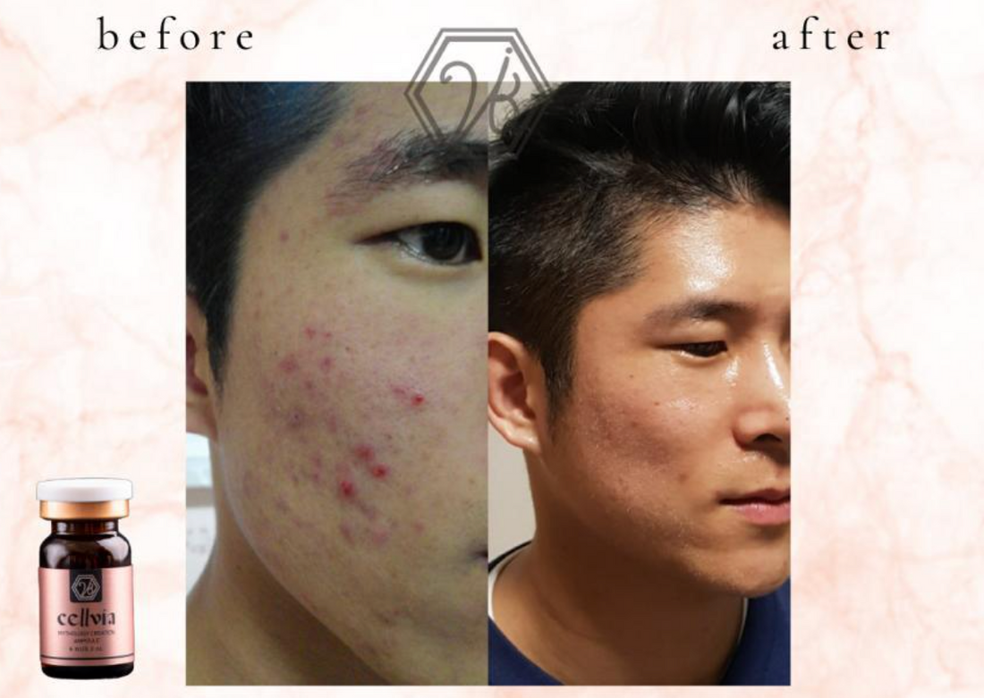 Resolved Acne Issues With Its Anti-Inflammatory Properties!