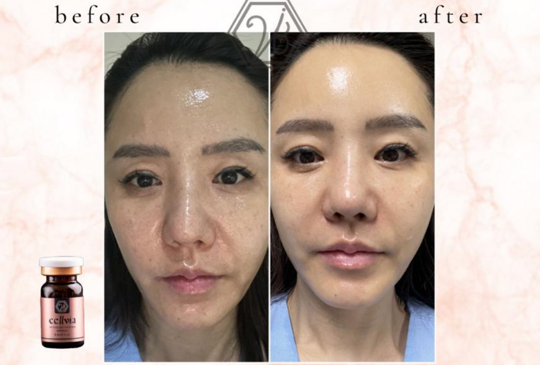 Non-Invasive Solution for Glowy Skin & Defined Jawline!